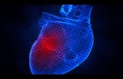 Tailor Made Sleeve implant to prevent aortic enlargement for people with Marfan Syndrome